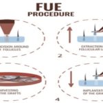 Top 6 Reasons To Choose Follicular Unit Extraction (FUE) Hair Treatment